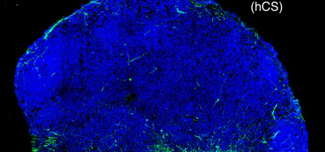 Mini cervelli 3D mostrano 'in diretta' lo sviluppo delle malattie