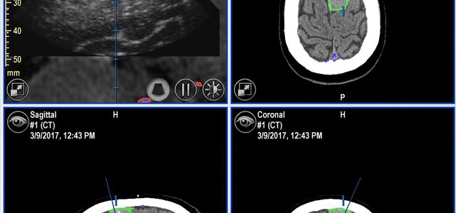 Al “Pugliese Ciaccio” le ecografie intraoperatorie e la neuronavigazione assistita