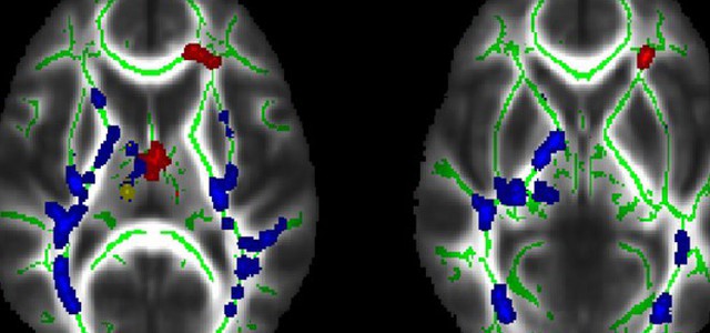 Viste nel cervello le spie dell'anoressia