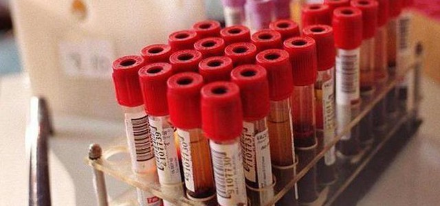 Epilessia, prelievo sangue rivela risposta bimbi a farmaci