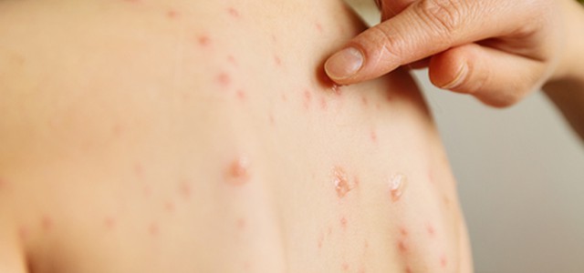 Quasi 3.000 casi di morbillo in meno di 6 mesi, 180 neonati