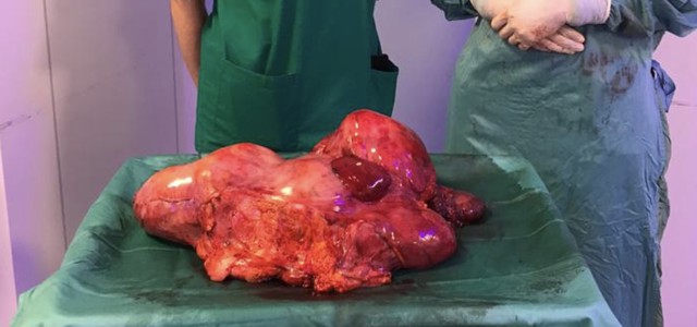 ASPORTATO TUMORE DI 7,5 KG IN UNA GIOVANE DONNA ALL'ANNUNZIATA DI COSENZA. E’ RECORD IN CALABRIA E CI SONO POCHI PRECEDENTI IN ITALIA.