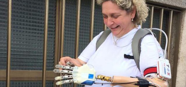 Mano bionica impiantata in una donna italiana