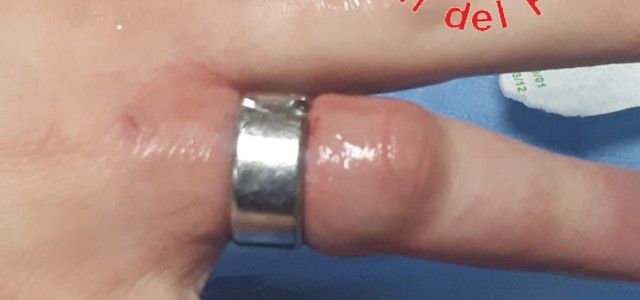 In Ospedale con anello incastrato, intervengono i Vigili