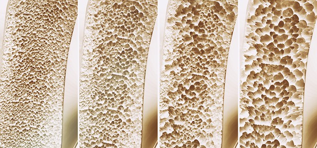 SCREENING GRATUITO SU OSTEOPOROSI AL CAMPUS UNIVERSITARIO A GERMANETO