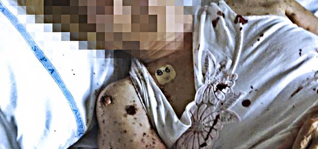 Formiche nel letto d'ospedale a Napoli, Lorenzin invia task force e Nas