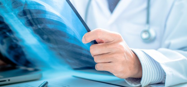 Tumore al polmone, verso una terapia chemio-free