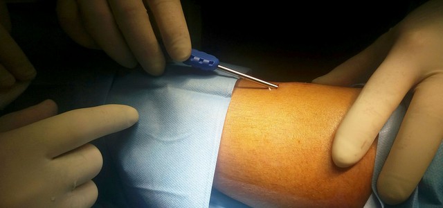 Impiantato sensore sottocutaneo per monitoraggio continuo della glicemia in tre giovani diabetici