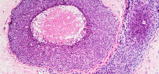 Sfida contro il tumore al seno, si sperimenta il vaccino