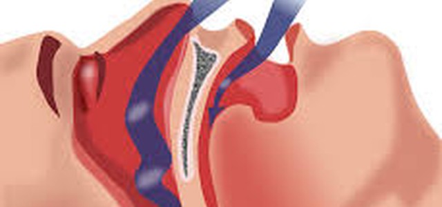 Università di Catanzaro brevetta apparecchio per apnee notturne