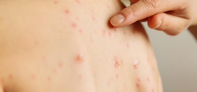 Morbillo, bimbo morto a Catania. In Sicilia la maggioranza delle infezioni dal 2018