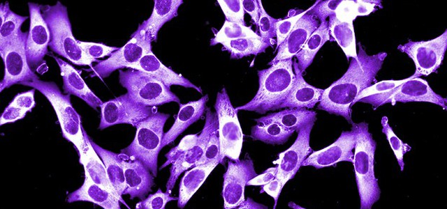 Farmaco comune contro l'ipertensione blocca la crescita del melanoma