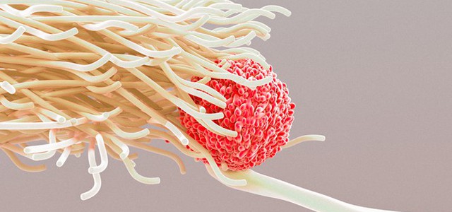 Tumore al seno con metastasi curato dalle cellule della stessa paziente